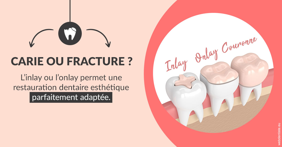 https://dr-minh-phan.chirurgiens-dentistes.fr/T2 2023 - Carie ou fracture 2