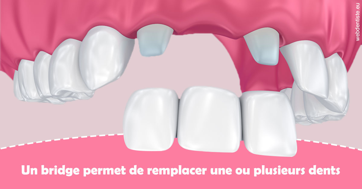 https://dr-minh-phan.chirurgiens-dentistes.fr/Bridge remplacer dents 2