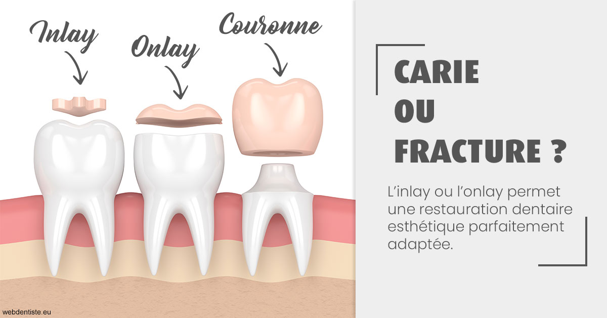 https://dr-minh-phan.chirurgiens-dentistes.fr/T2 2023 - Carie ou fracture 1