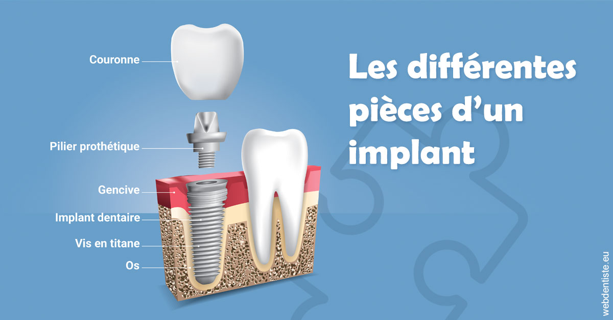 https://dr-minh-phan.chirurgiens-dentistes.fr/Les différentes pièces d’un implant 1