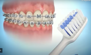 Brossage des dents avec des brackets